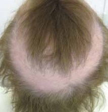 Подкова вытяжной алопеции